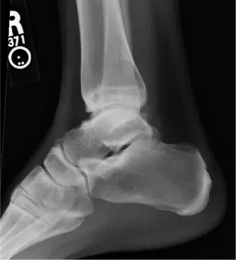 صورة توضيحية لـ مفصل الكاحل الصناعي لراقصات الباليه: حل شامل لخشونة الكاحل المتقدمة