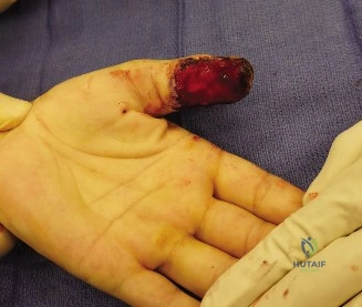 Orthopedic Hand Cases: A Patient's Journey, Is a Year Old a Factor?