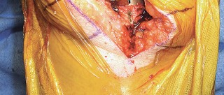 Illustration 51 for Mastering TKA: Essential Methods of Rotational Alignment