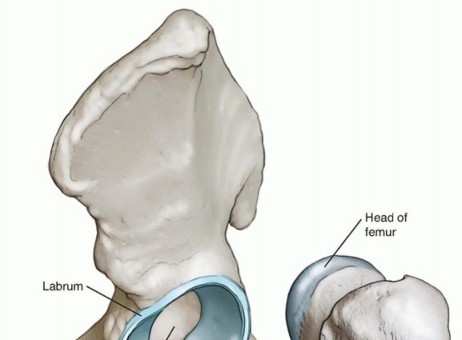 Hip Arthroscopy: Your Minimally Invasive Solution for Hip Pain