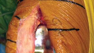 Illustration 33 for Minimize Pain, Maximize Recovery: TKA with Parapatellar