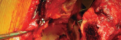 صورة طبية: طول عمر مكون الحُق الأسمنتي في مفصل الورك: مفتاح الاستقرار والديمومة مع الأستاذ الدكتور محمد هطيف في صنعاء