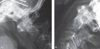 Illustration 23 for Spine Cases: Consider the Patient for Accurate Diagnosis