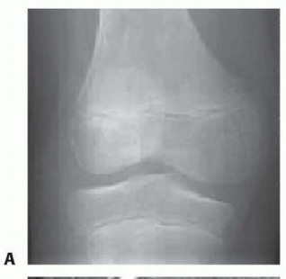 Meniscoplasty: Your Solution for Discoid Lateral Meniscus Pain