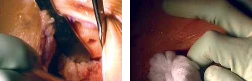 Illustration 28 for Cemented TKA Figure: Your Visual Guide to Surgical Success