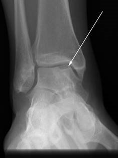 Illustration 29 for First Metatarsal Surgery: Expert Solutions for Foot & Ankle Pain