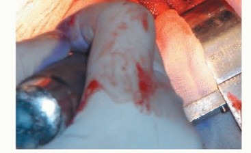 صورة طبية: نصف مفصل الورك: دليلك الشامل لدواعي الاستخدام والأنواع في صنعاء