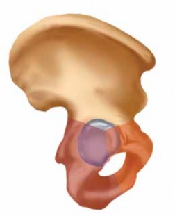 Spinal Pelvic Fixation: Open Reduction for Sacroiliac & Sacrum