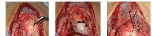 Illustration 5 for Optimizing ORIF for Distal Humerus: Prevent Class II HO