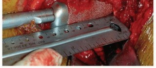 Illustration 17 for Revision THA: Why Extensively Porouscoated Cylindrical Stems Excel