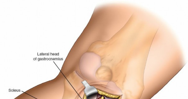 Figure 16: Intraoperative fluoroscopic image showing screw placement in AP view.