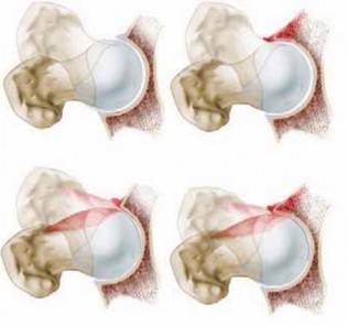 Mastering Anterolateral Femoral Headneck Impingement: Anterior Approach
