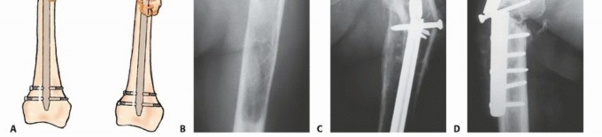 Illustration 26 for Plain Radiograph Showing MBD: Surgical Planning to Prevent Failures