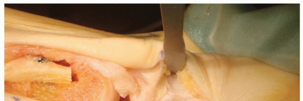 Illustration of akin osteotomy akin - Dr. Mohammed Hutaif