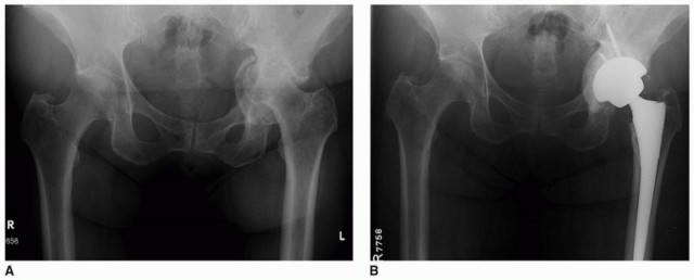 صورة طبية: تثبيت مفصل الورك بدون أسمنت: دليل شامل لمرضى استبدال الورك مع الأستاذ الدكتور محمد هطيف