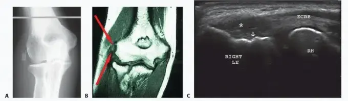 مرفق التنس: الدليل الشامل لعلاج ألم الكوع والعودة لحياة طبيعية مع الأستاذ الدكتور محمد هطيف