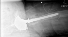Illustration 8 for Mastering Severe Bone Loss: Highly Porous Metal for Revision THA