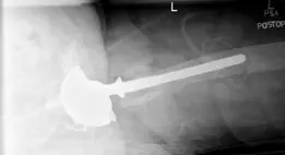 صورة توضيحية لـ فقدان العظم الشديد ومراجعة استبدال مفصل الورك بمعدن عالي المسامية: حلول متقدمة مع الأستاذ الدكتور محمد هطيف في صنعاء