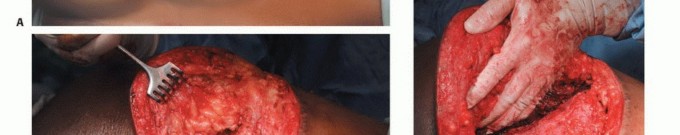 توضيح طبي: جراحة نقائل الحوض: حل شامل لآلام العظام واستعادة الحركة مع الأستاذ الدكتور محمد هطيف