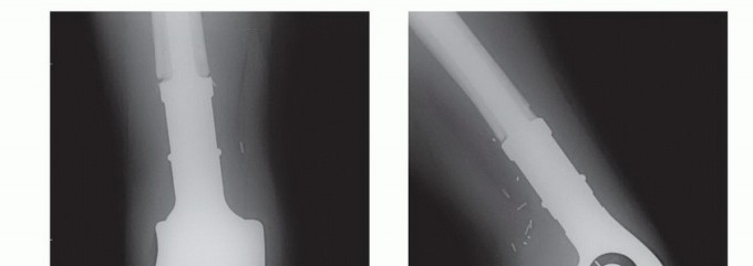 صورة طبية: النقائل العظمية الفخذية: دليل شامل للعلاج واستعادة الوظيفة مع الأستاذ الدكتور محمد هطيف في صنعاء