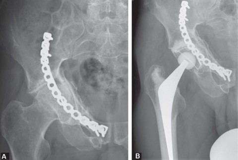 Navigating Early THA for Fractures of the Acetabulum