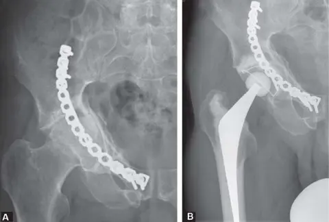صورة توضيحية لـ استبدال مفصل الورك المبكر لكسور الحُق: استعادة الحركة والأمل في صنعاء مع الأستاذ الدكتور محمد هطيف