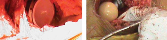 صورة طبية: مفصل الفخذ الصناعي قصير الجذع METHA: حلول مبتكرة للحفاظ على العظم في صنعاء مع الأستاذ الدكتور محمد هطيف