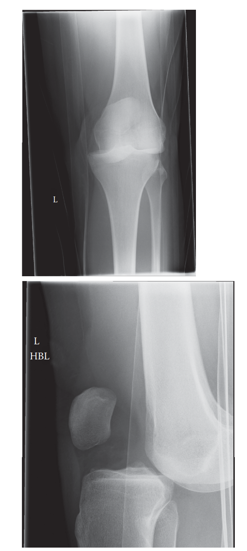Illustration of knee dislocation knee - Dr. Mohammed Hutaif