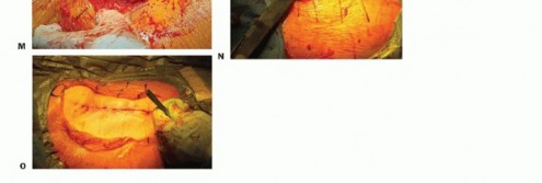 صورة طبية: نصف مفصل الورك: دليلك الشامل لدواعي الاستخدام والأنواع في صنعاء