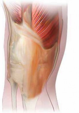 Illustration of correct stiffness revision - Dr. Mohammed Hutaif