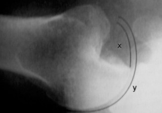 Illustration 21 for Right Shoulder Pain? Avoid This Common X-ray Mistake.
