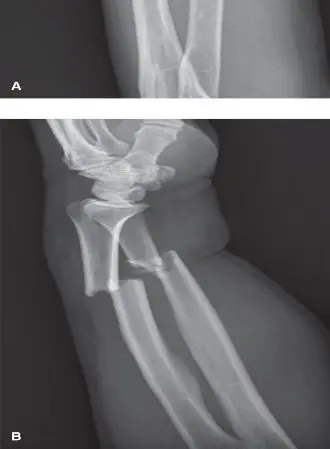 صورة توضيحية لـ تقوس الكعبرة: دليل شامل لاستعادة وظيفة الساعد المثلى مع الأستاذ الدكتور محمد هطيف