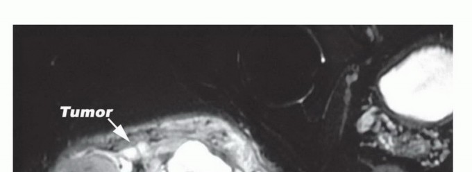 صورة توضيحية لـ ساركوما الأرداف: الحفاظ على العصب الوركي بدلاً من استئصال نصف الحوض مع الأستاذ الدكتور محمد هطيف