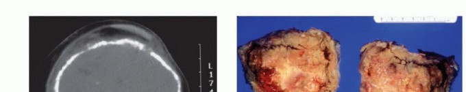 صورة طبية: معالجة الأورام المعقدة في قصبة الساق القريبة حلول الحفاظ على الأطراف