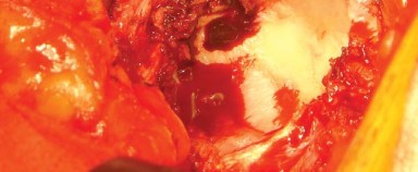 Illustration 15 for Approaches Posterolateral Surgical: A Guide to Enhanced Hip Surgery