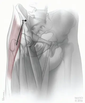 صورة توضيحية لـ النهج الأمامي لاستبدال مفصل الورك الكلي: ثورة في جراحة الورك مع الأستاذ الدكتور محمد هطيف في صنعاء