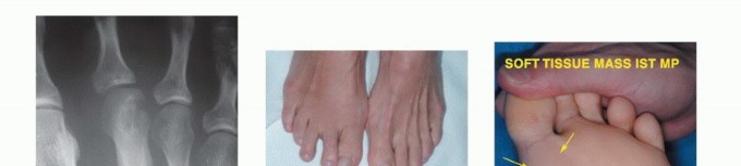 صورة طبية: أورام القدم: دليلك الشامل للعلاج، البتر، والاستئصال مع الأستاذ الدكتور محمد هطيف في صنعاء