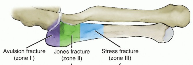 Illustration of proximal fifth metatarsal - Dr. Mohammed Hutaif