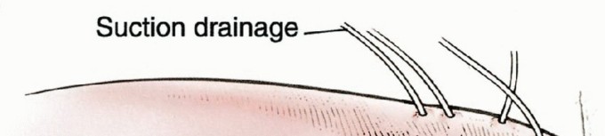 Illustration of preservation of the sciatic - Dr. Mohammed Hutaif