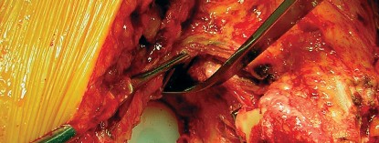 صورة طبية: طول عمر مكون الحُق الأسمنتي في مفصل الورك: مفتاح الاستقرار والديمومة مع الأستاذ الدكتور محمد هطيف في صنعاء