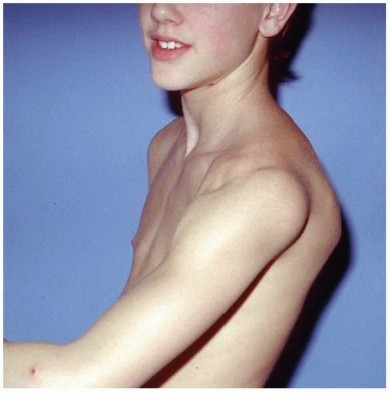 Mastering the Treatment of Recurrent Posterior Shoulder Instability