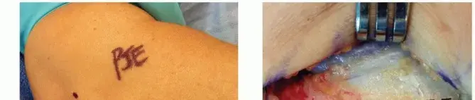 صورة توضيحية لـ مرفق التنس (التهاب اللقيمة الوحشية): دليل شامل للمرضى نحو التعافي في اليمن والخليج العربي