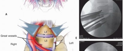 Illustration 8 for Anterior Lumbar Interbody: Fusion, Disc Replacement & Pain Relief