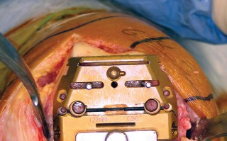 Illustration 23 for Minimize Pain, Maximize Recovery: TKA with Parapatellar