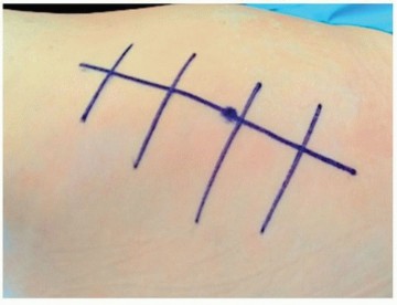 Unlock Precision: The Direct Lateral Approach for THA