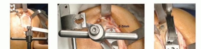 Illustration 9 for Unicondylar Knee Arthroplasty: Is This Your Solution to Knee Pain?