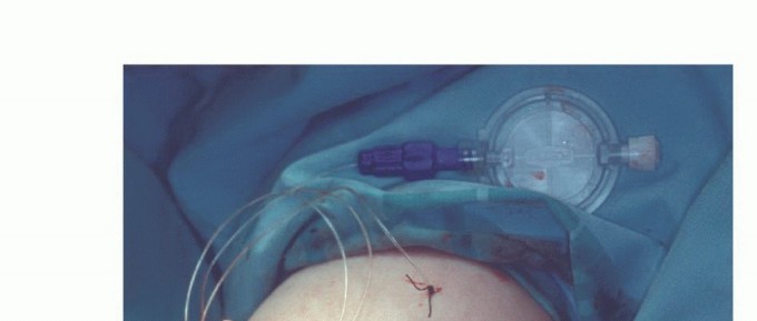 صورة توضيحية لـ بتر الذراع فوق وتحت الكوع: متى ولماذا يصبح ضرورة طبية؟ دليل شامل من الأستاذ الدكتور محمد هطيف