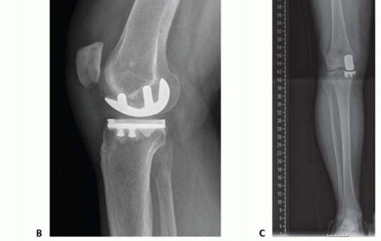 Illustration 26 for Unicondylar Knee Arthroplasty: Is This Your Solution to Knee Pain?