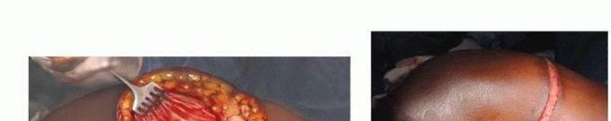 توضيح طبي: جراحة نقائل الحوض: حل شامل لآلام العظام واستعادة الحركة مع الأستاذ الدكتور محمد هطيف