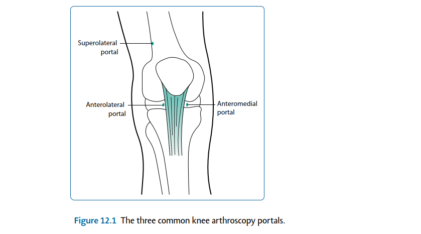 Illustration 1 for Mastering Soft Tissue Knee Surgery: Preoperative Planning & Indications